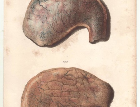 Figure 4 Duodenum Lock